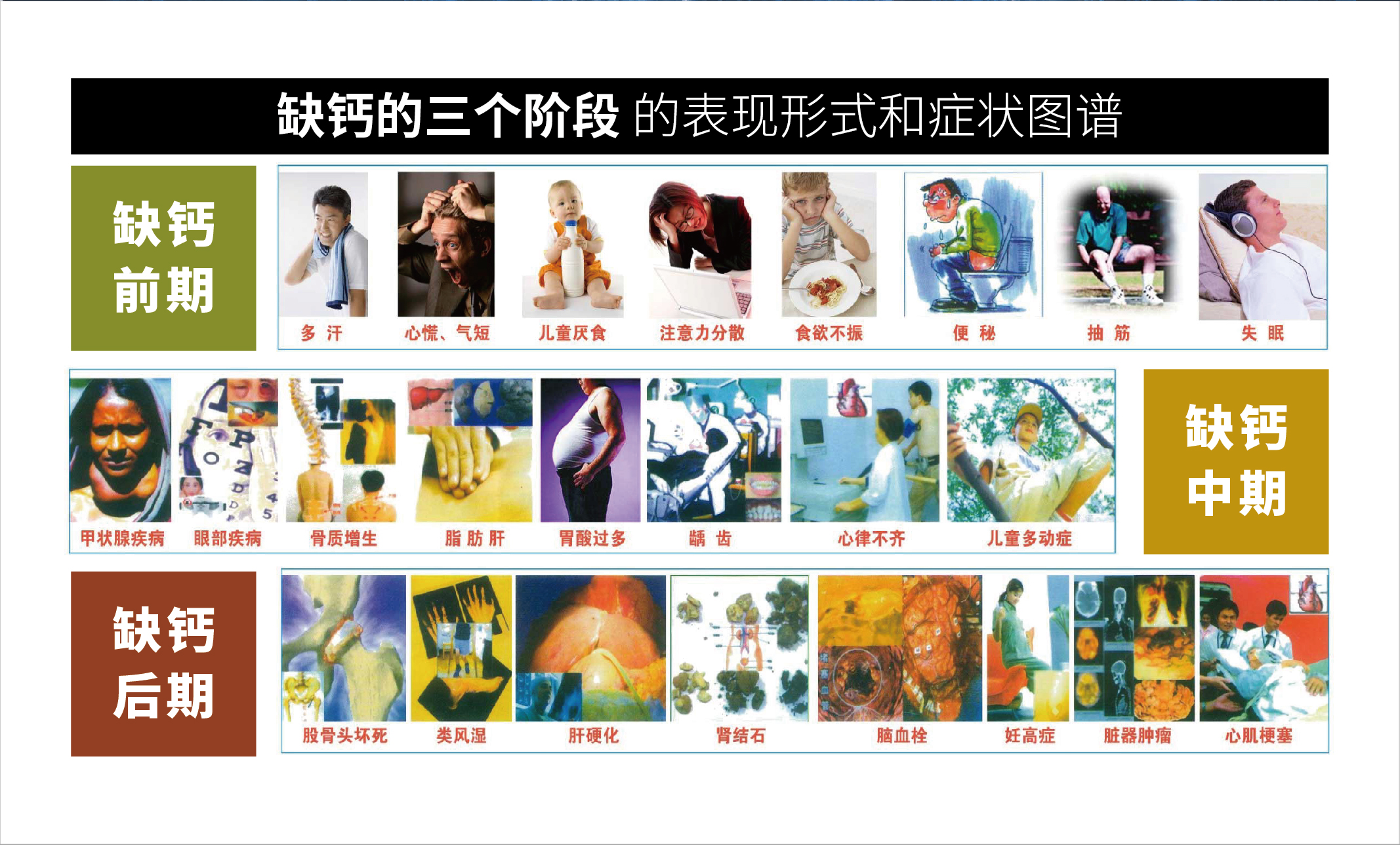 天门冬氨酸钙_缺钙的三阶段表现形式图谱